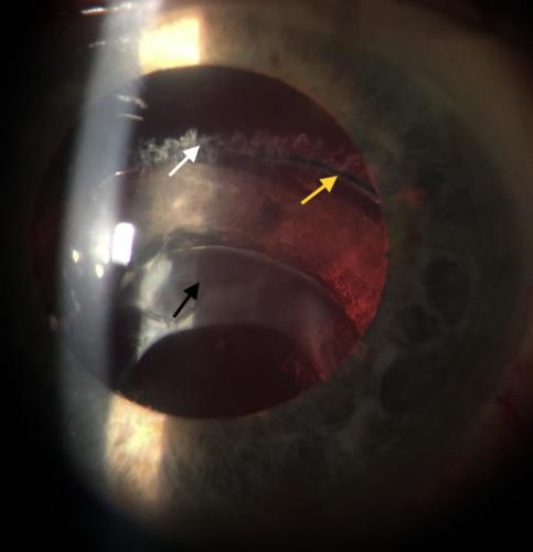 Artificial intraocular lens - dislocation in the pseudoexfoliation syndrome